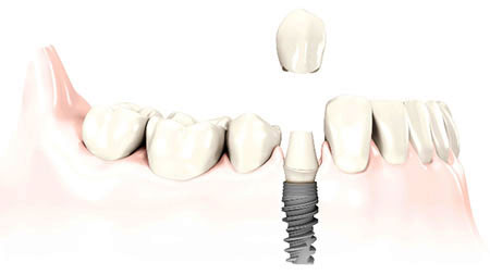 Single Dental Implant